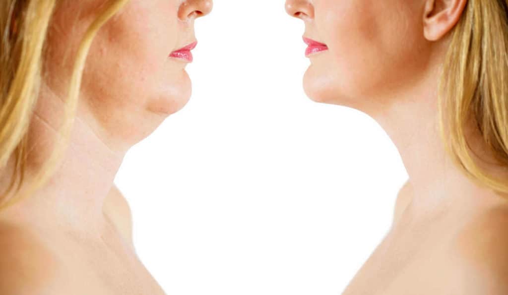 Double Chin treatment Derby before and after results