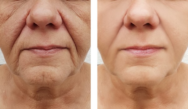 Learn more about Morpheus8 Treatment Derby today!