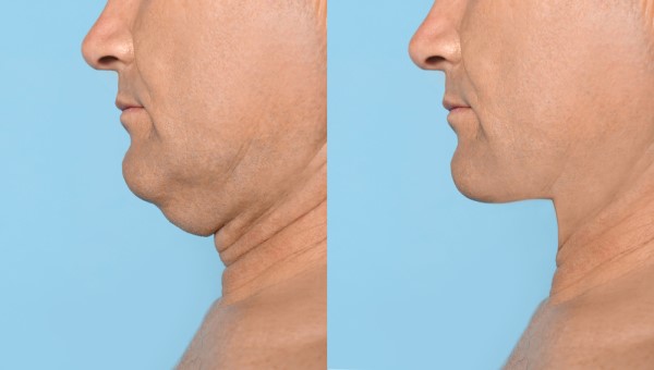 Which Non-Surgical Treatments Work Best for Jowls and Loose Skin Derby?