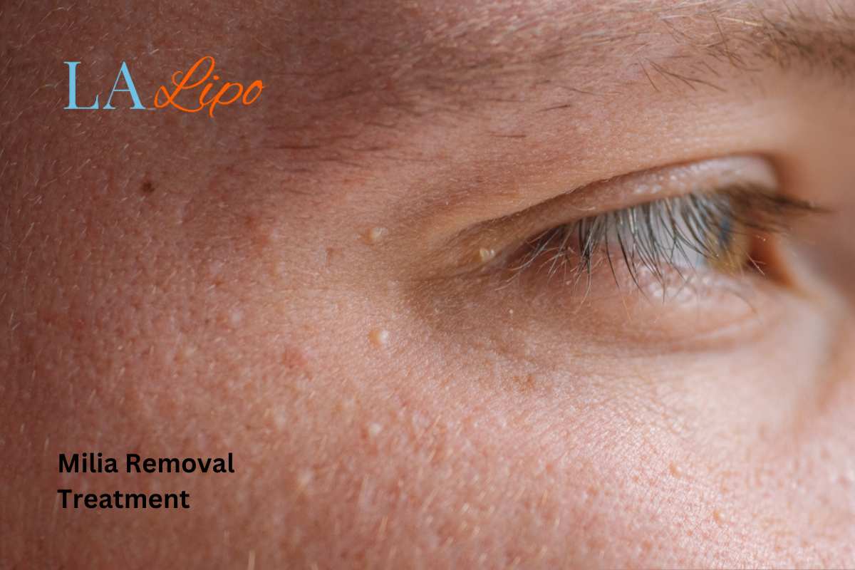 Cryopen Milia Removal: Is It the Easiest and Safest Option Derby?