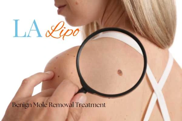 Why getting moles removed Derby can boost your confidence!