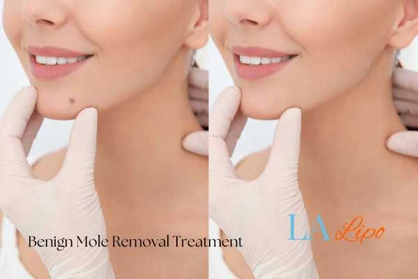 woman's before and after mole removal Derby results