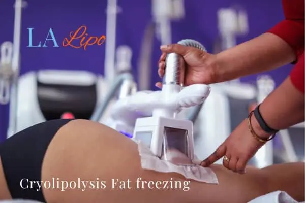 women getting fat freezing Derby