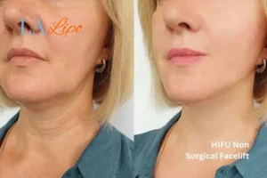 hi-fu for wrinkles Derby before and after results