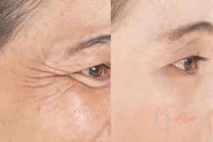 Before and after results of woman - HI-fu wrinkles reduction treatment Derby