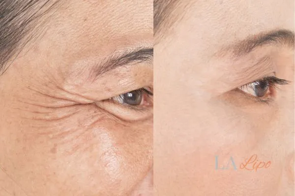 Before and after results of woman - HI-fu wrinkles reduction treatment Derby