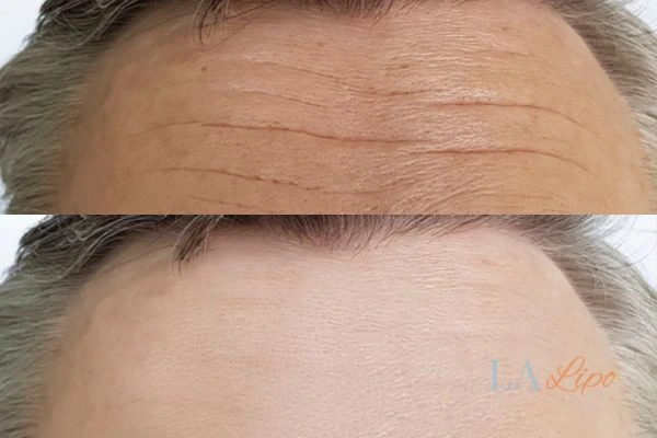 results of HIFU Derby on mans forehead to help reduce lines and wrinkles