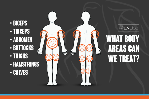 Graphic to show areas you can have LA-EMS Body Sculpting Derby treatment.
