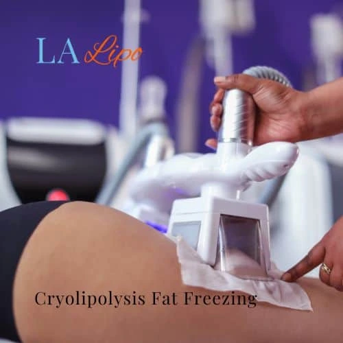 fat freezing - Cryolipolysis Derby