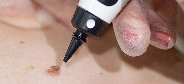 skin tag removal using cryopen Derby