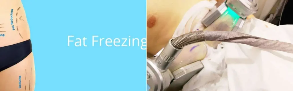 Fat freezing Derby on multiple areas of the body