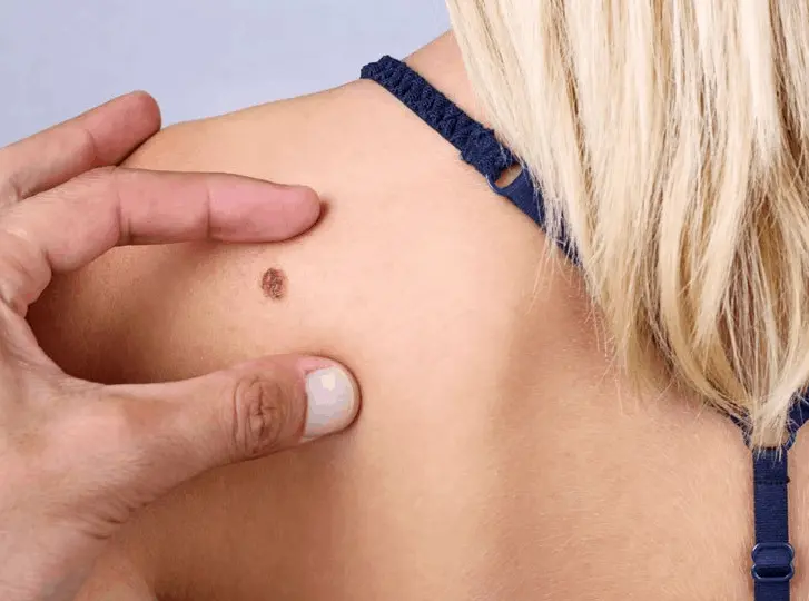 woman having mole removal Derby consultation before treatment.