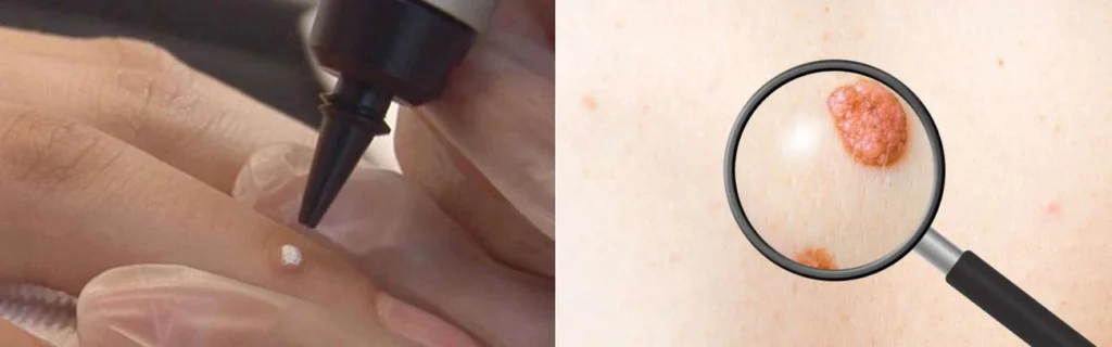 Person getting moles removed with cryopen Derby