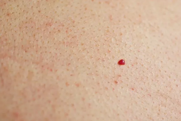 close up of a cherry angioma Derby