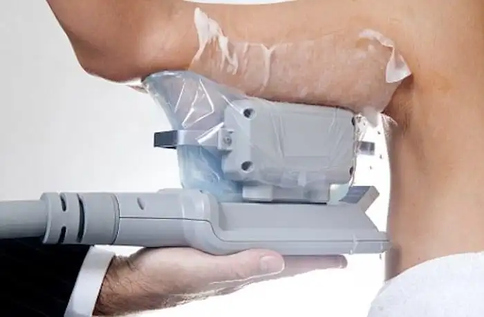 Picture of fat freezing Derby on the upper arms.