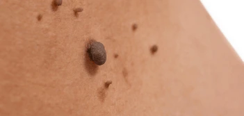 image of a skin tag Derby