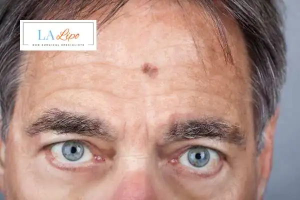 Solar Lentigo Removal Derby image of man with mark on his forehead
