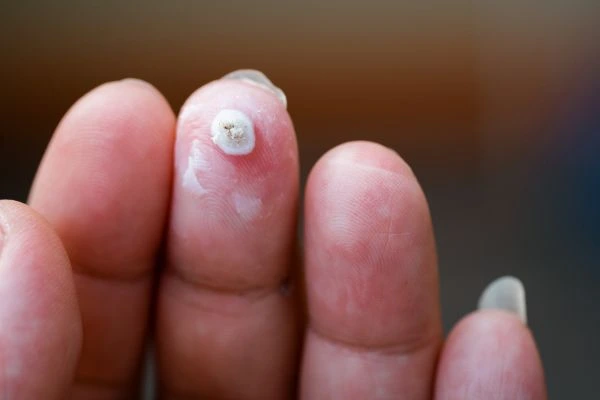 wart on person finger - cryotherapy to treat from LA LIPO Derby