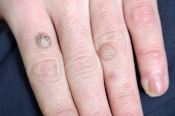 photo of warts on person hand - see wart removal Derby from LA LIPO