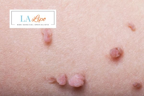 Does cryopen skin tag removal Derby hurt? Find out now call our team today!