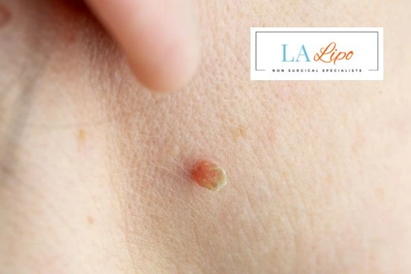 Book skin tag removal Derby today speak to our team now!