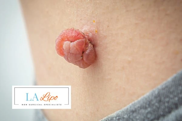 Interested in skin tag removal Derby? Concerned about the pain? Find out more today!