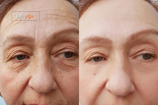 The powerful benefits of Morpheus8 Treatment Derby - Call Our team today!