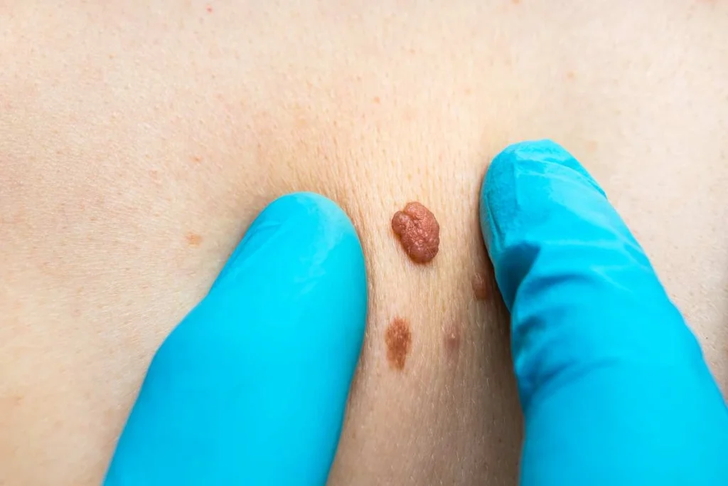 LA LIPO Cryopen Lesion Removal Prices Derby