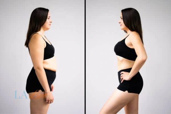 Picture of womans before and after using LA-EMS body sculpting to improve her core strength Derby
