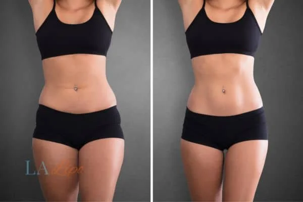 before and after results of non-surgical treatment to help a woman's body image and mental health Derby