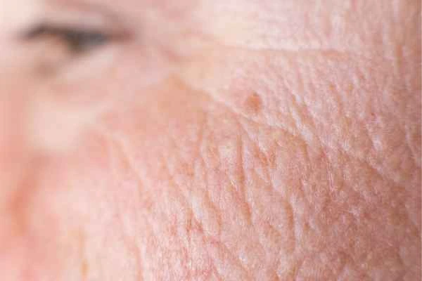 close up picture of a woman's face showing an age spot Derby