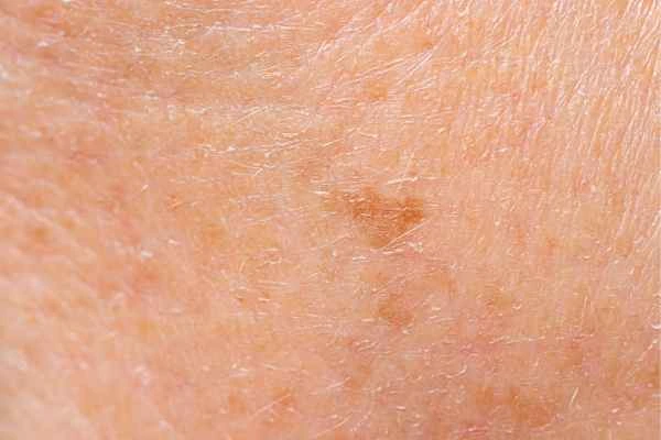 close up picture of age spots Derby