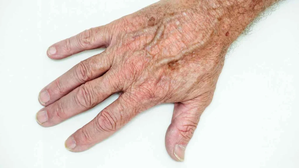 Male hand showing age spot Derby