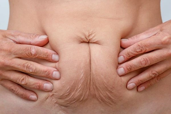 Image of a woman's stomach with loose skin - example of skin tightening Derby options