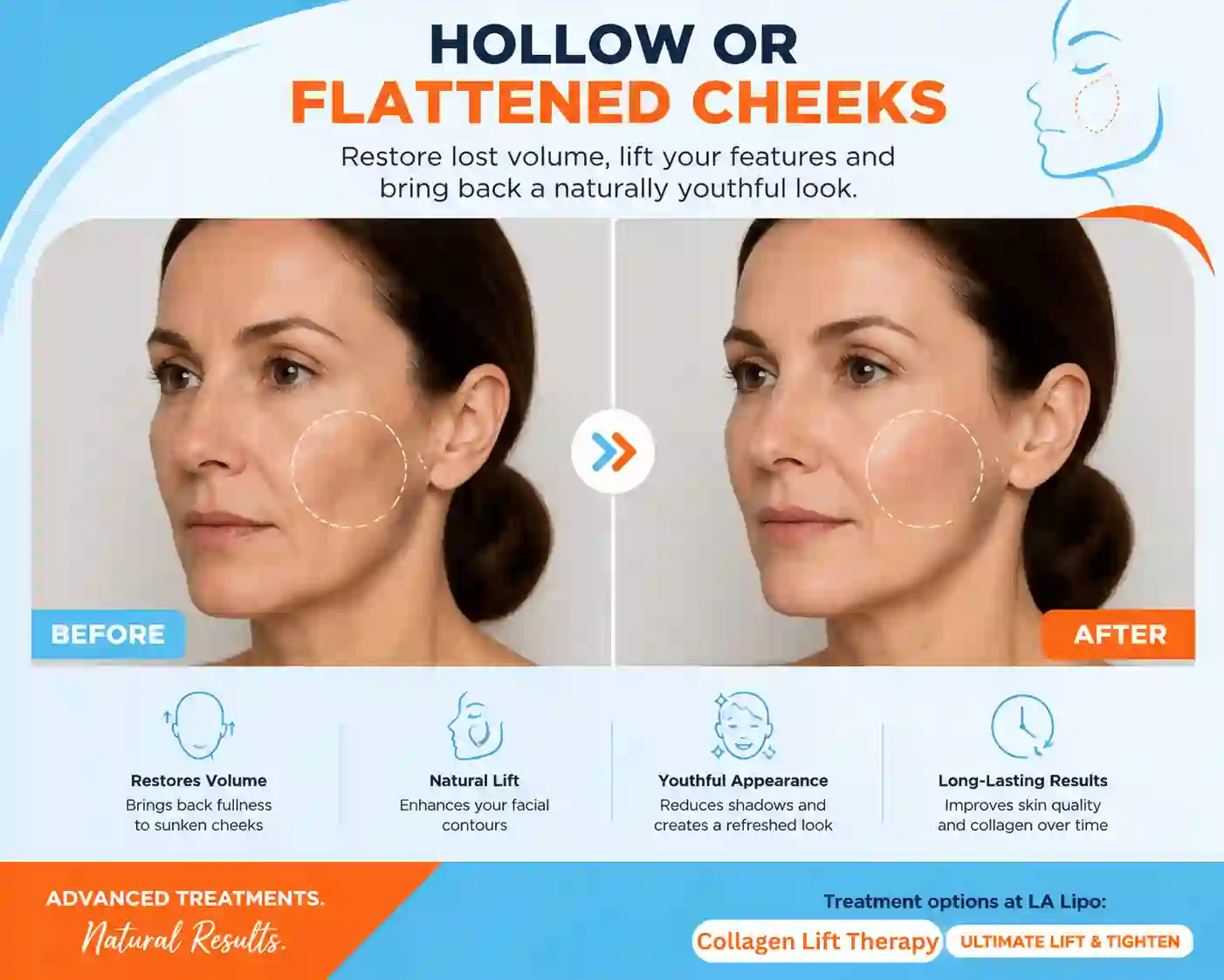 Sign #4: Hollow or Flattened Cheeks Derby
