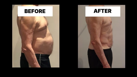 What Symptoms Can Diastasis Recti Cause in Men? Weak Core, Back Pain and Poor Posture Derby
